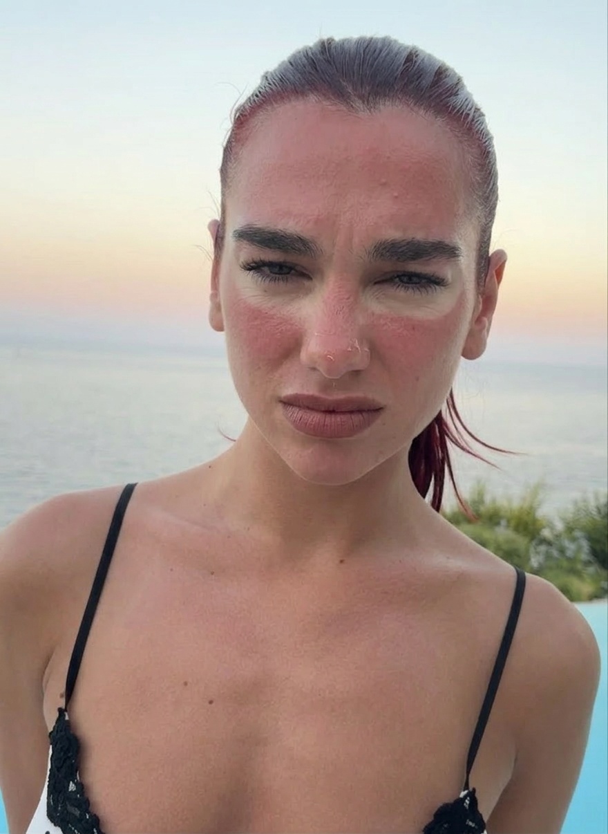 Sunburn